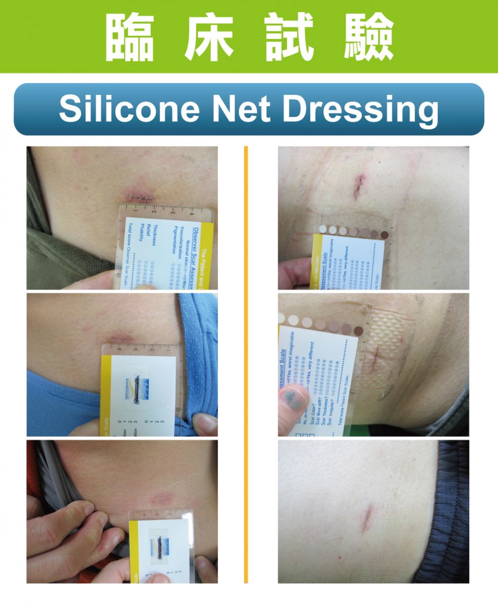 Na Ultra Silicone Net Wound Dressing